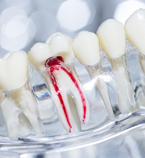 Endodontologie (Wurzelkanal- behandlungen)